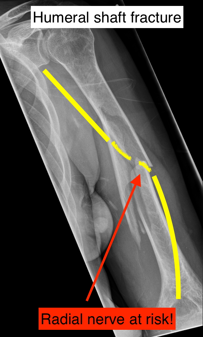 Nerve injury after fracture or dislocation
